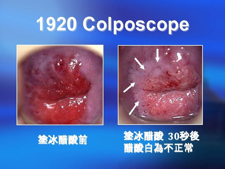 1920 Colposcope 塗冰醋酸前 塗冰醋酸 30秒後 醋酸白為不正常 