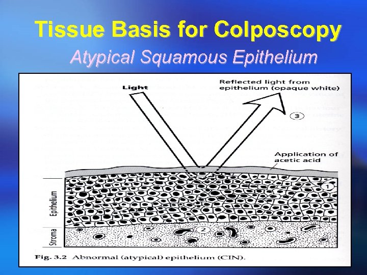 Tissue Basis for Colposcopy Atypical Squamous Epithelium 