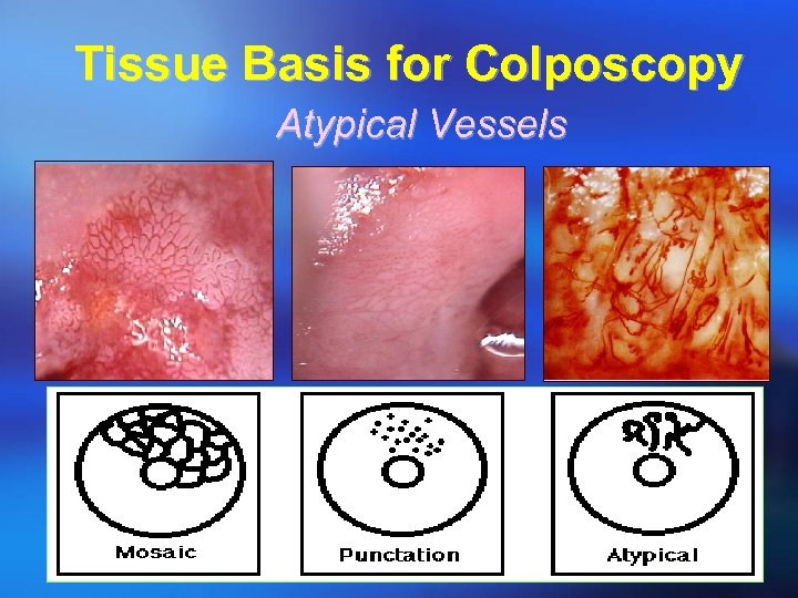 Tissue Basis for Colposcopy Atypical Vessels 