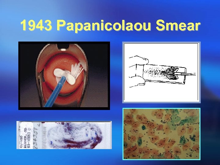 1943 Papanicolaou Smear 