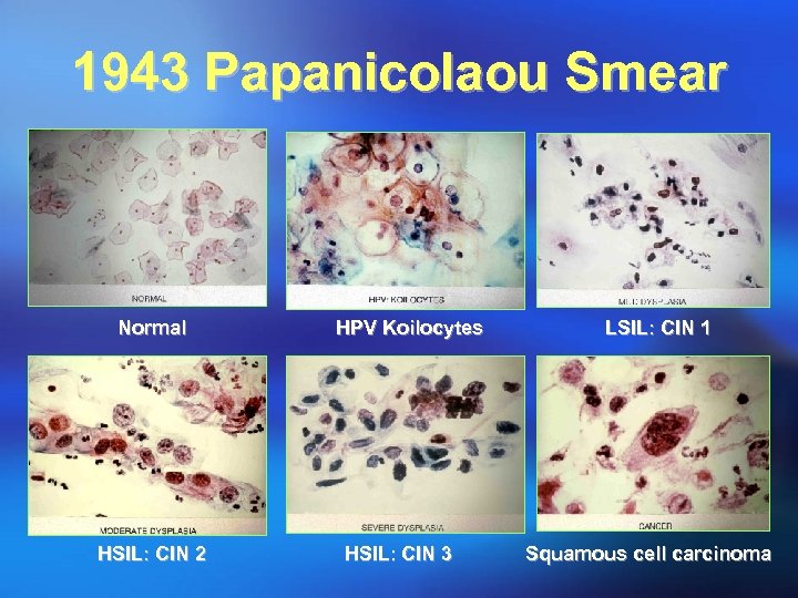 1943 Papanicolaou Smear Normal HPV Koilocytes LSIL: CIN 1 HSIL: CIN 2 HSIL: CIN