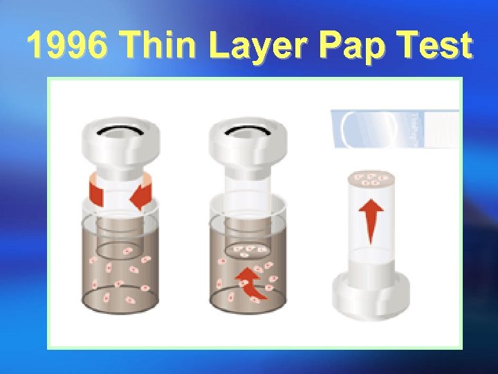 1996 Thin Layer Pap Test 