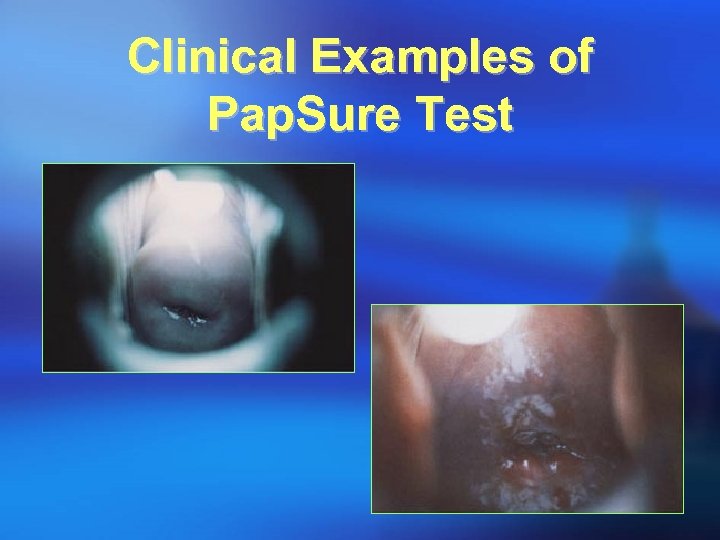 Clinical Examples of Pap. Sure Test 