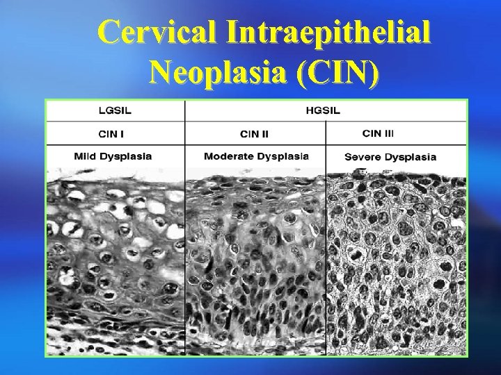 Cervical Intraepithelial Neoplasia (CIN) 