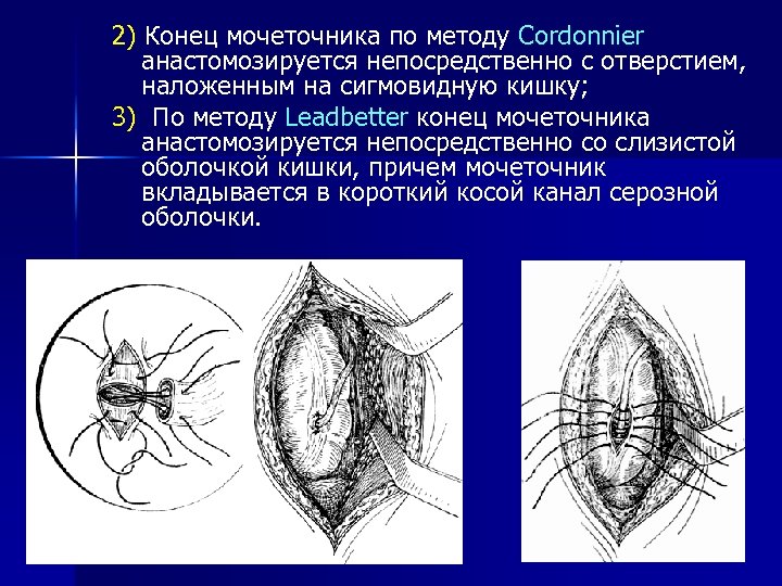 2) Конец мочеточника по методу Cordonnier анастомозируется непосредственно с отверстием, наложенным на сигмовидную кишку;