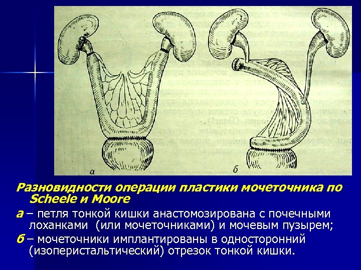 Разновидности операции пластики мочеточника по Scheele и Moore a – петля тонкой кишки анастомозирована