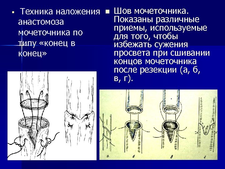 § Техника наложения анастомоза мочеточника по типу «конец в конец» n Шов мочеточника. Показаны