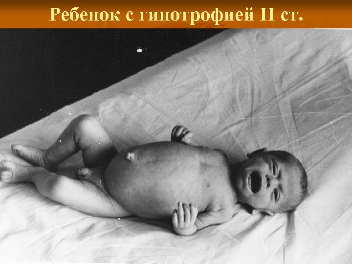 Ребенок с гипотрофией II ст. 