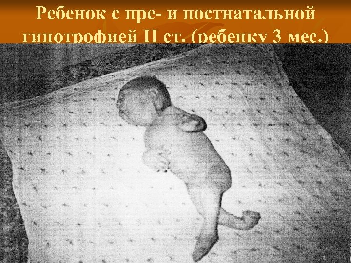 Ребенок с пре- и постнатальной гипотрофией II ст. (ребенку 3 мес. ) 
