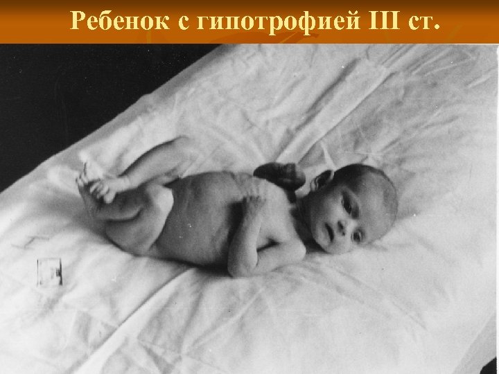 Ребенок с гипотрофией III ст. 