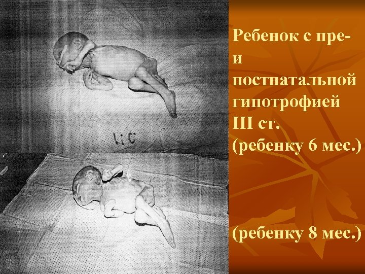 Ребенок с преи постнатальной гипотрофией III ст. (ребенку 6 мес. ) (ребенку 8 мес.