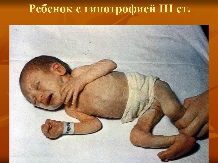 Ребенок с гипотрофией III ст. 