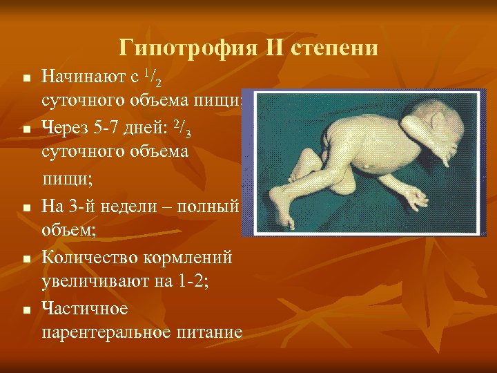 Гипотрофия ІІ степени n n n Начинают с 1/2 суточного объема пищи; Через 5