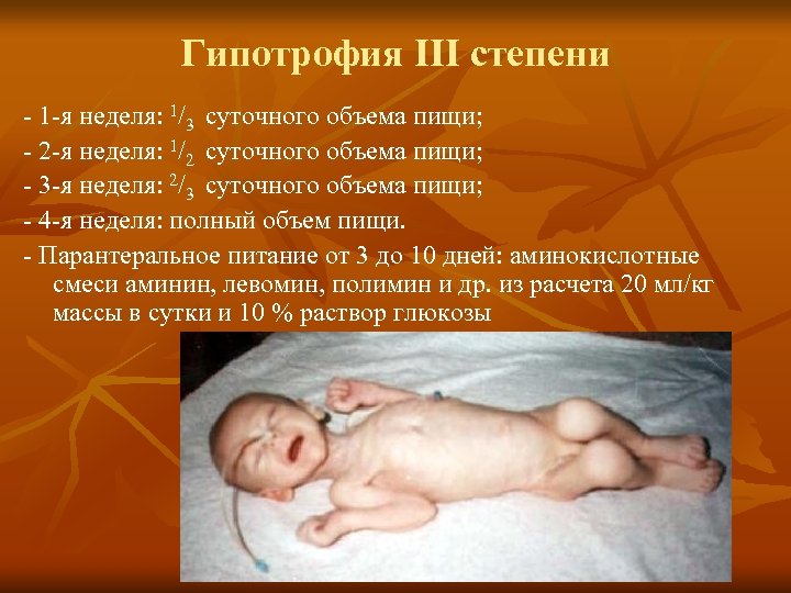 Гипотрофия ІІІ степени - 1 -я неделя: 1/3 суточного объема пищи; - 2 -я