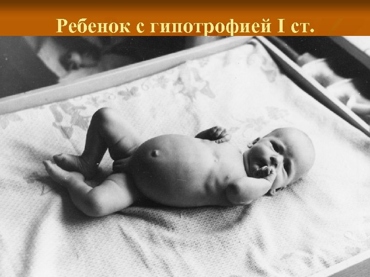 Ребенок с гипотрофией I ст. 