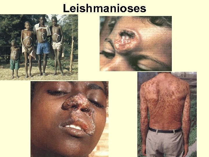 Leishmanioses 