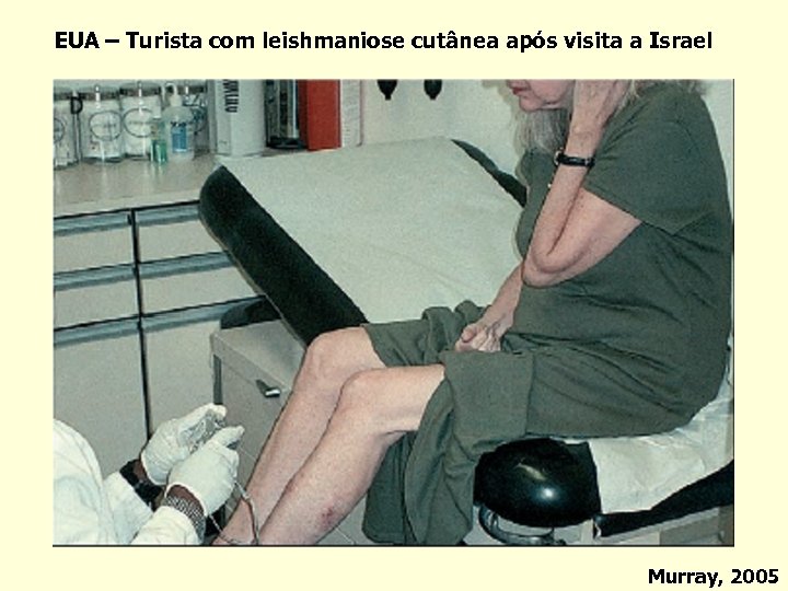 EUA – Turista com leishmaniose cutânea após visita a Israel Murray, 2005 