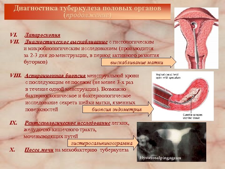 Диагностика туберкулеза половых органов (продолжение) VI. Лапароскопия VII. Диагностическое выскабливание с гистологическим и микробиологическим