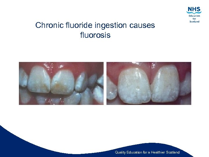 Chronic fluoride ingestion causes fluorosis Quality Education for a Healthier Scotland 