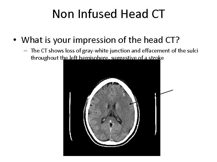 Non Infused Head CT • What is your impression of the head CT? –