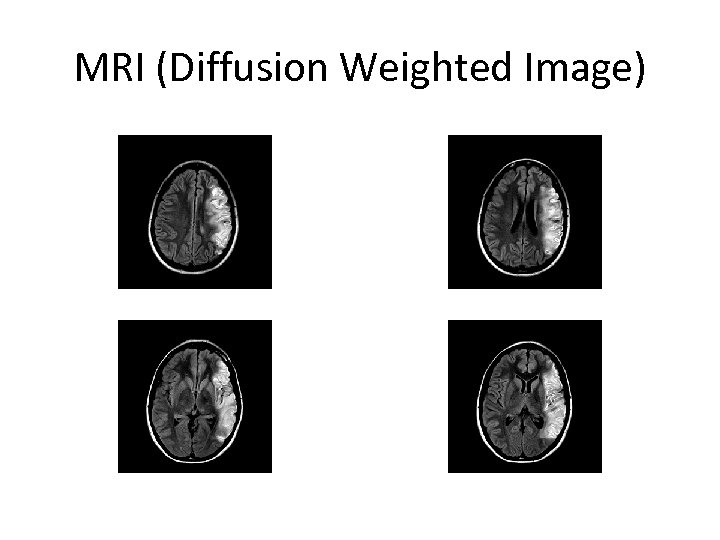 MRI (Diffusion Weighted Image) 