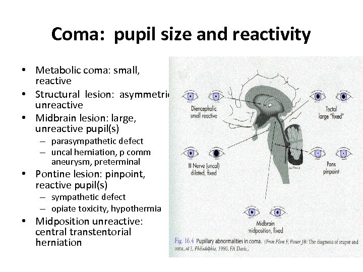 Coma: pupil size and reactivity • Metabolic coma: small, reactive • Structural lesion: asymmetric,