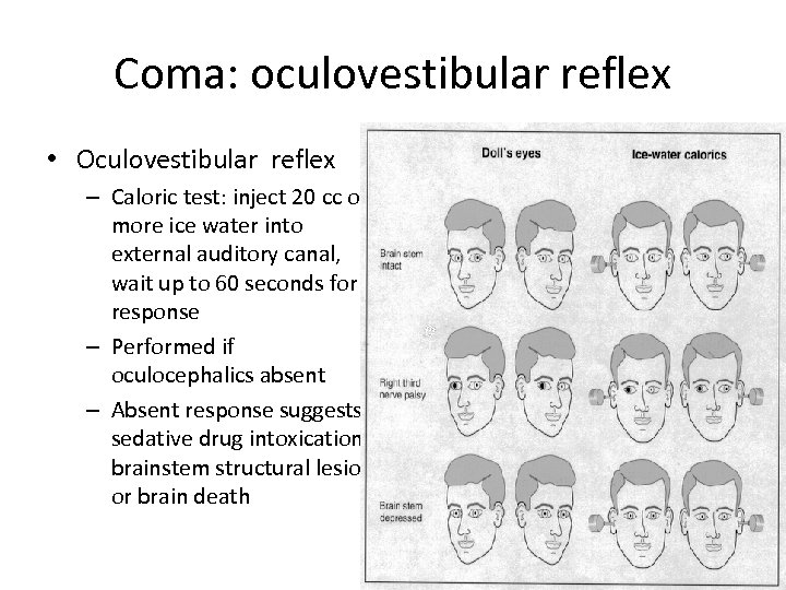 Coma: oculovestibular reflex • Oculovestibular reflex – Caloric test: inject 20 cc or more