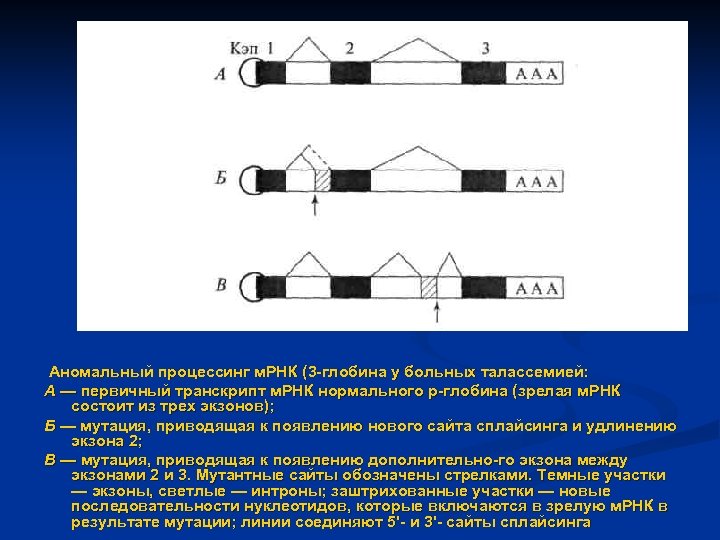 Аномальный процессинг м. РНК (3 глобина у больных талассемией: А — первичный транскрипт м.