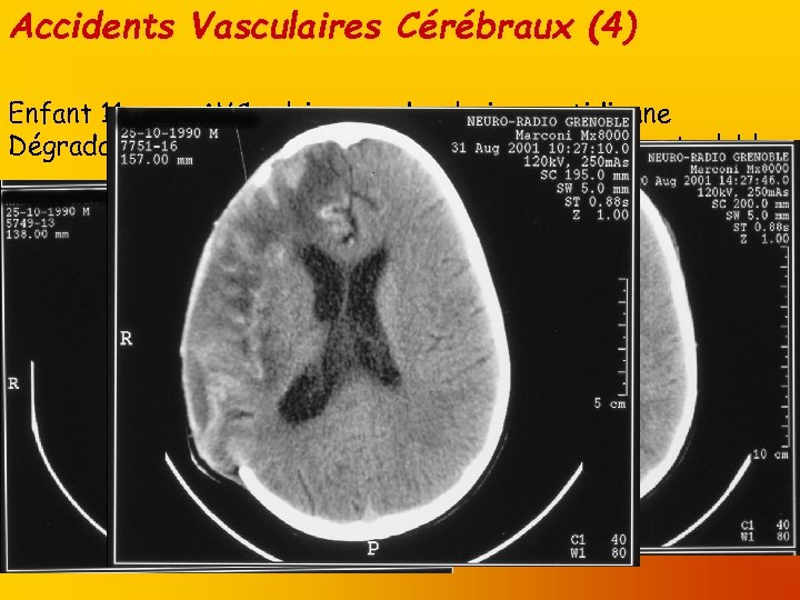 Accidents Vasculaires Cérébraux (4) Enfant 11 ans ; AVC sylvien sur dysplasie carotidienne Dégradation