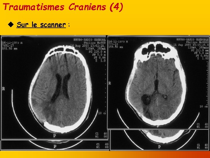 Traumatismes Craniens (4) u Sur le scanner : 