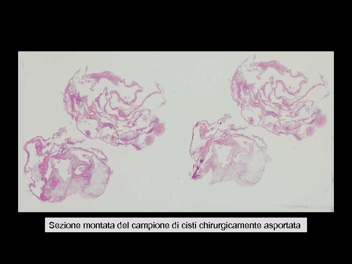 Sezione montata del campione di cisti chirurgicamente asportata 