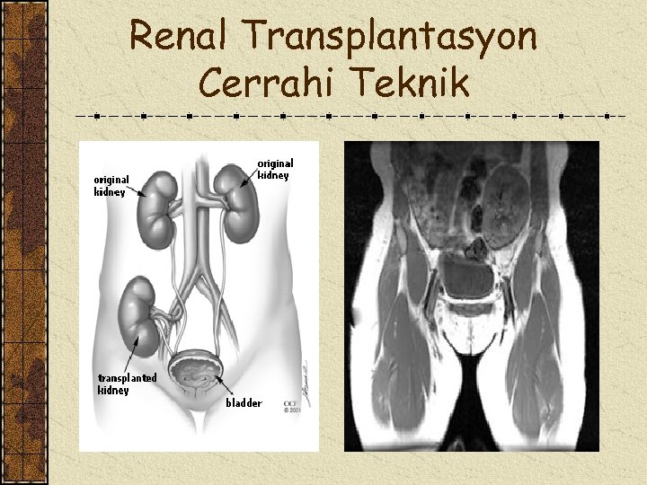 Renal Transplantasyon Cerrahi Teknik 