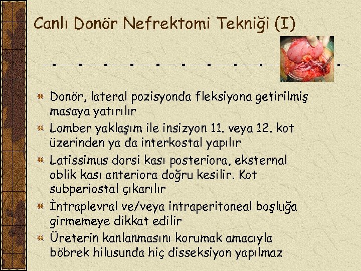 Canlı Donör Nefrektomi Tekniği (I) Donör, lateral pozisyonda fleksiyona getirilmiş masaya yatırılır Lomber yaklaşım