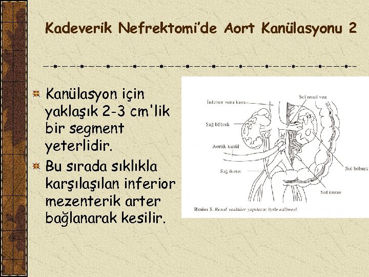 Kadeverik Nefrektomi’de Aort Kanülasyonu 2 Kanülasyon için yaklaşık 2 -3 cm'lik bir segment yeterlidir.