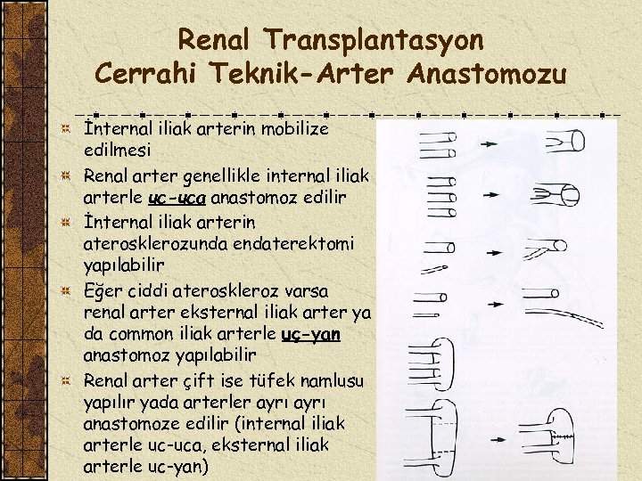 Renal Transplantasyon Cerrahi Teknik-Arter Anastomozu İnternal iliak arterin mobilize edilmesi Renal arter genellikle internal