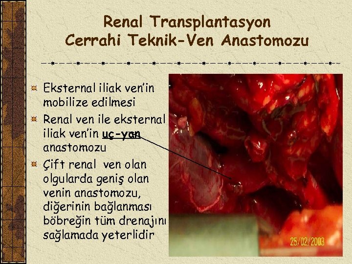 Renal Transplantasyon Cerrahi Teknik-Ven Anastomozu Eksternal iliak ven’in mobilize edilmesi Renal ven ile eksternal