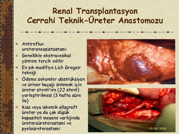 Renal Transplantasyon Cerrahi Teknik-Üreter Anastomozu Antireflux ureteroneosistostomi Genellikle ekstravesikal yöntem tercih edilir En sık
