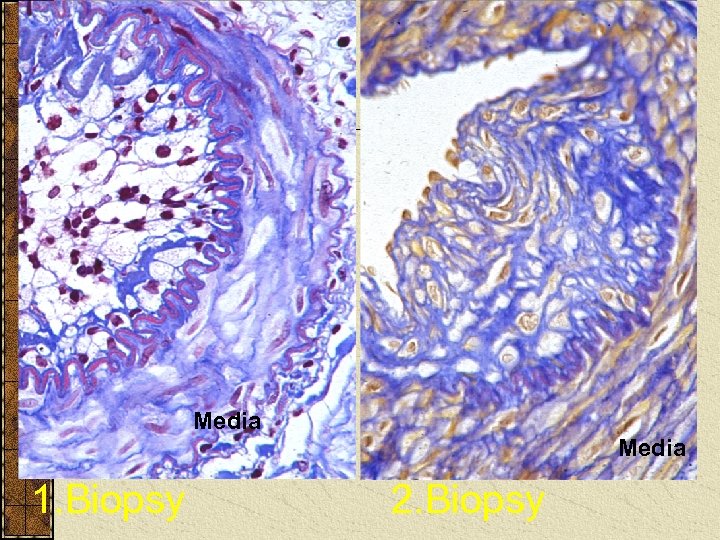 Media 1. Biopsy 2. Biopsy 