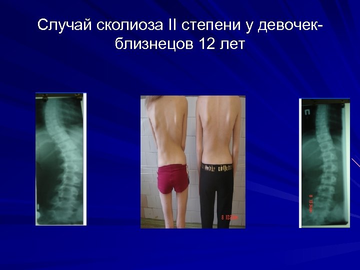 Случай сколиоза II степени у девочек близнецов 12 лет 
