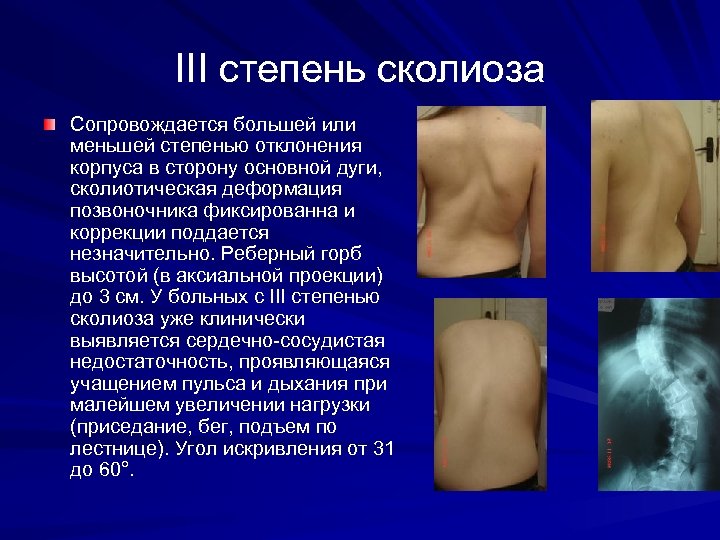 III степень сколиоза Сопровождается большей или меньшей степенью отклонения корпуса в сторону основной дуги,