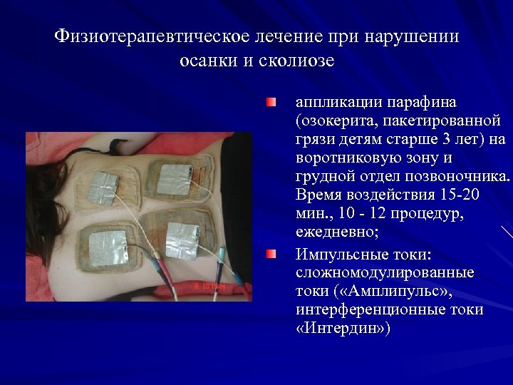 Физиотерапевтическое лечение при нарушении осанки и сколиозе аппликации парафина (озокерита, пакетированной грязи детям старше