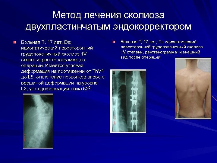 Метод лечения сколиоза двухпластинчатым эндокорректором Больная Т, 17 лет, Ds: идиопатический левосторонний грудопоясничный сколиоз
