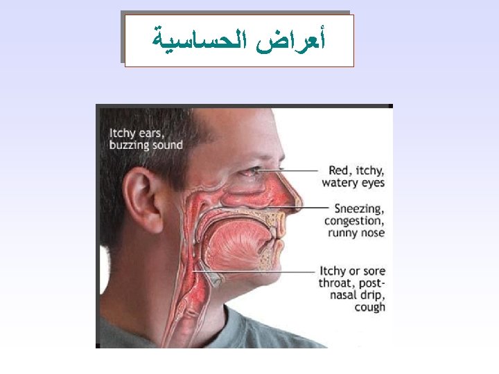  ﺃﻌﺮﺍﺽ ﺍﻟﺤﺴﺎﺳﻴﺔ 