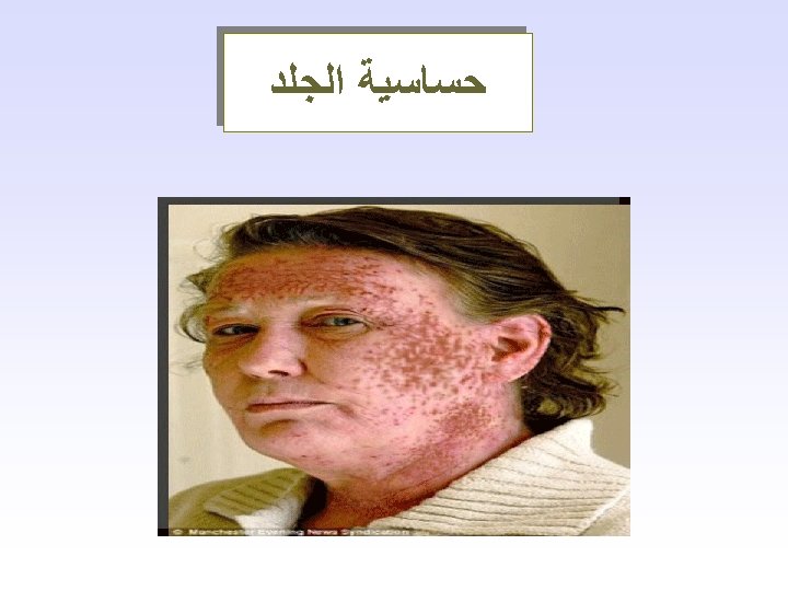  ﺣﺴﺎﺳﻴﺔ ﺍﻟﺠﻠﺪ 