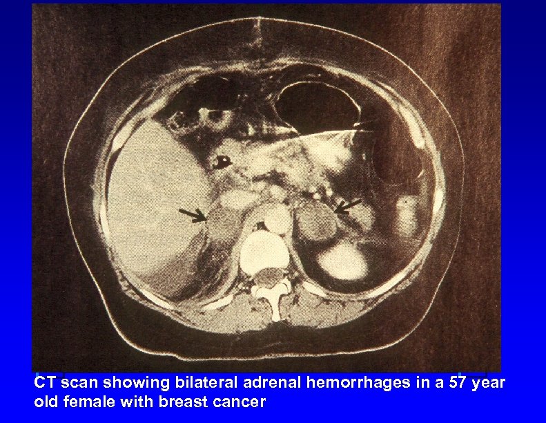 CT scan showing bilateral adrenal hemorrhages in a 57 year old female with breast