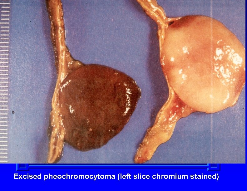 Excised pheochromocytoma (left slice chromium stained) 