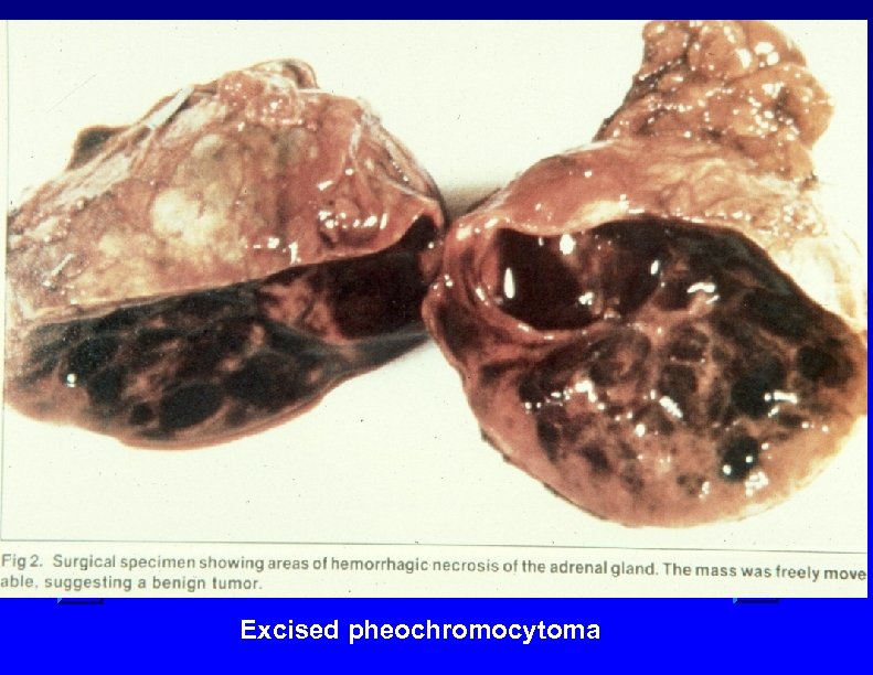 Excised pheochromocytoma 