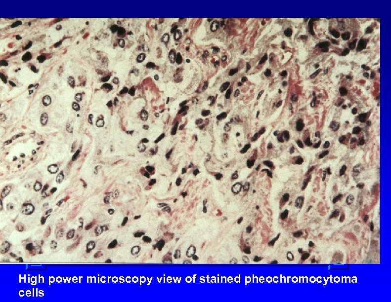 High power microscopy view of stained pheochromocytoma cells 
