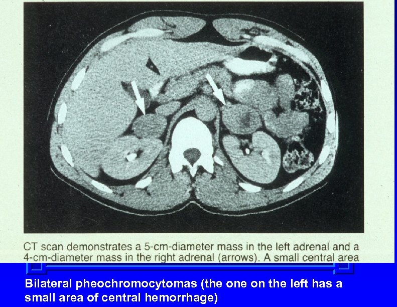 Bilateral pheochromocytomas (the on the left has a small area of central hemorrhage) 