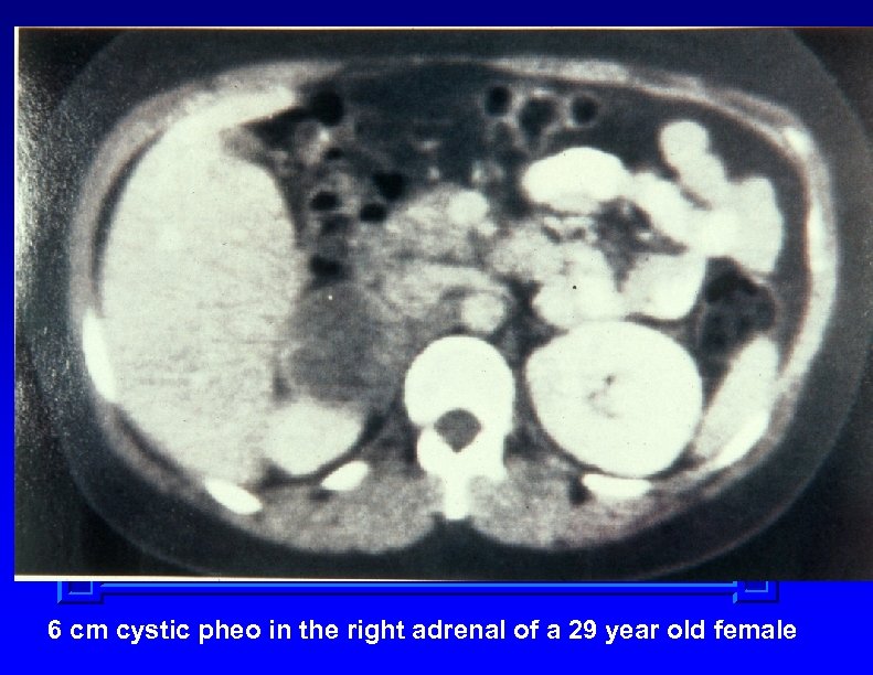 6 cm cystic pheo in the right adrenal of a 29 year old female